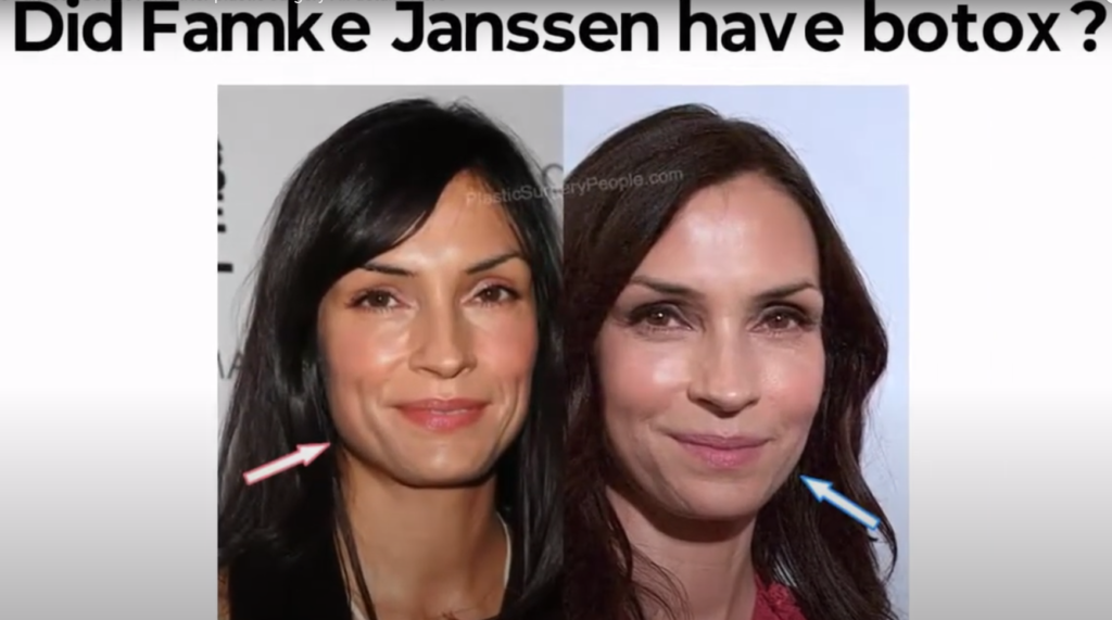 Famke Jenssen Botox